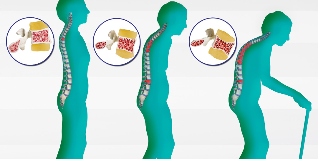 Are you at risk for Osteoporosis?